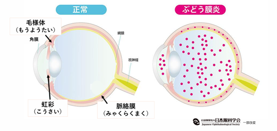 ぶどう膜炎