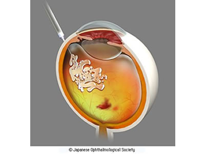 図３　硝子体内注射による薬物治療　