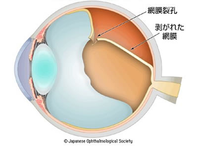 図１　裂孔原性網膜剥離