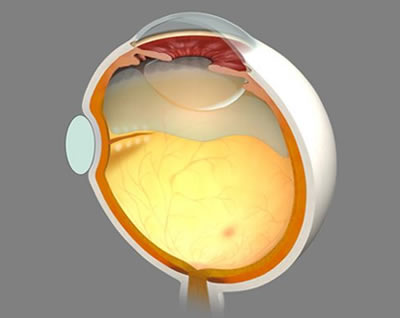 図2　網膜剥離に対する強膜内陥術