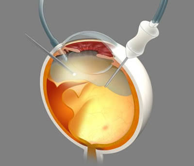 図3　網膜剥離に対する硝子体手術