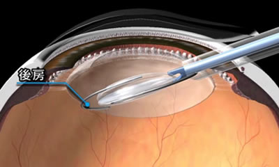 図２．眼内レンズの挿入（１）