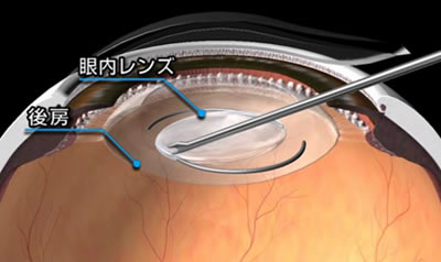 図３．眼内レンズの挿入（２）