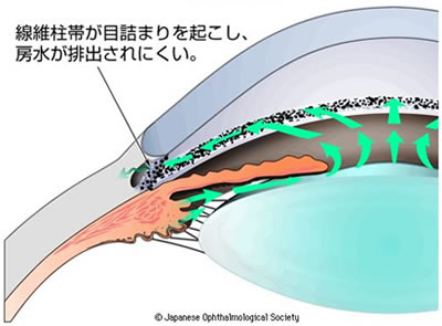 図2　隅角の広さによる緑内障の分類