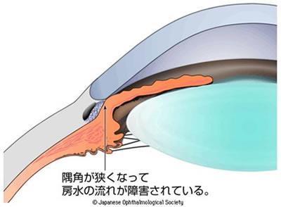 図2　隅角の広さによる緑内障の分類