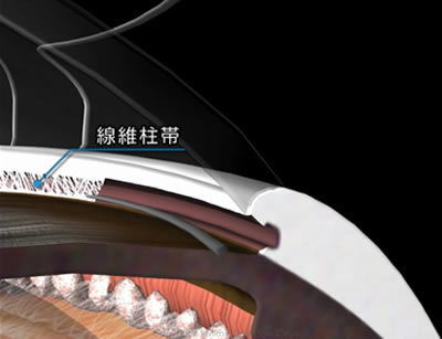 図４　流出路再建術　（トラベクロトミー）