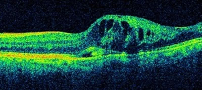 図２　黄斑浮腫（むくみ）を併発した網膜静脈分枝閉塞症の網膜断層検査（光干渉断層計）像