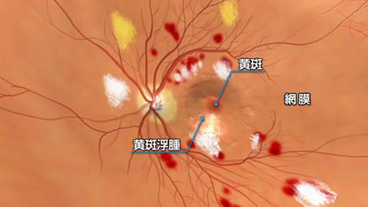 図１　糖尿病黄斑浮腫　