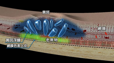 図１　糖尿病黄斑浮腫　