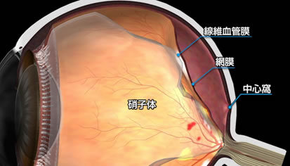 図２　糖尿病網膜症による網膜剥離（牽引性網膜剥離）