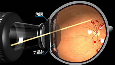 図a)　眼底へのレーザーの照射