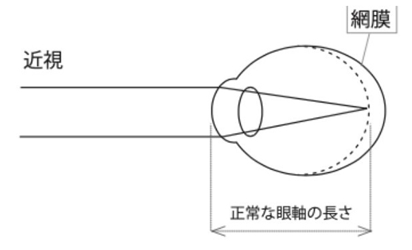 図1　近視についての図解